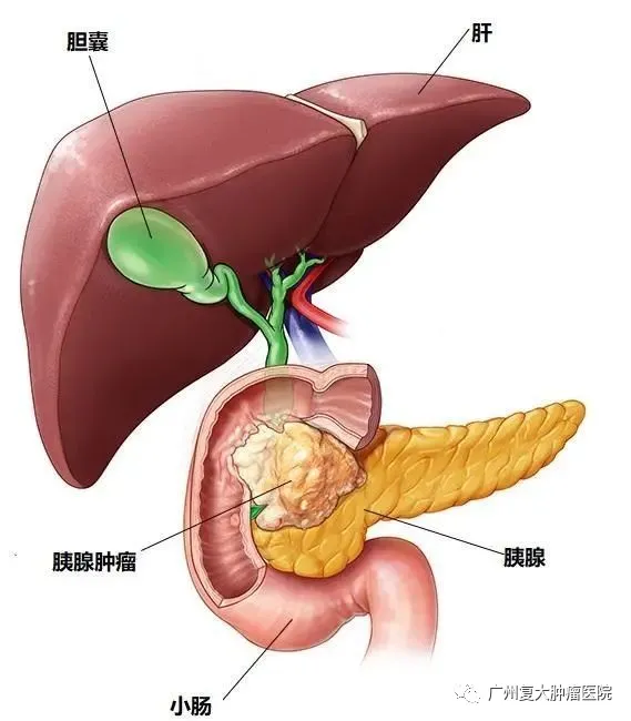 杭州肿瘤医院选择广州复大肿瘤医院：纳米刀可以治疗胰腺癌吗